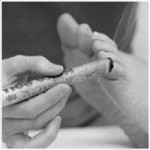 moxibustion